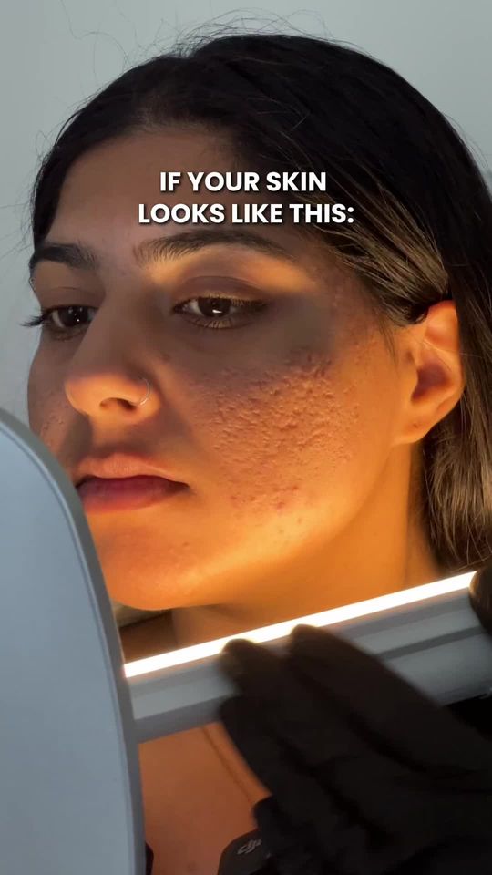 Video by Dr. Nadir Qazi: Your Acne Scar Journey Starts with the Right Consultation... The consultation process is one of t…
