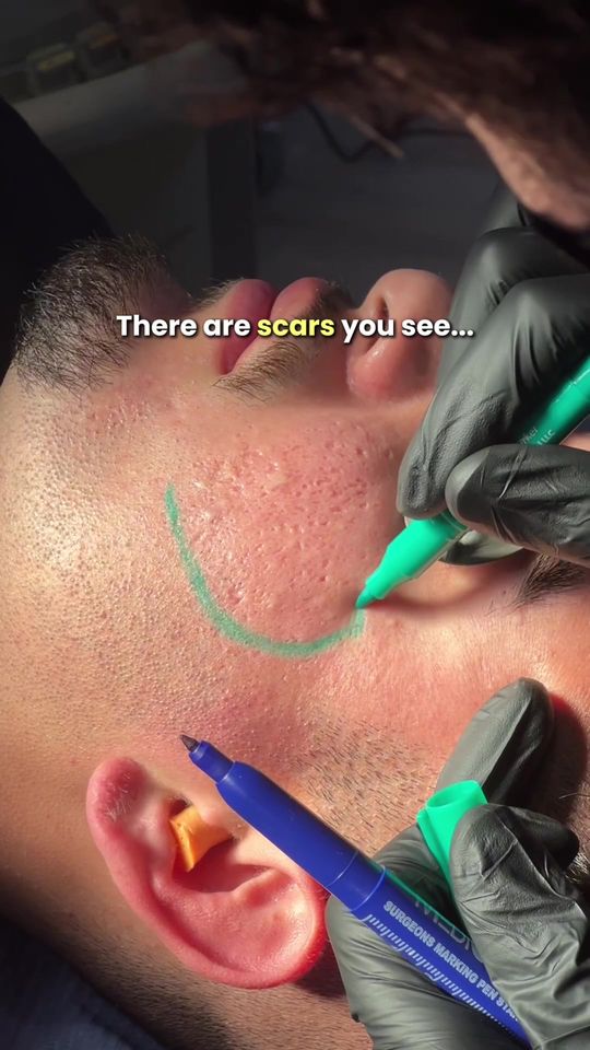 Video by Dr. Nadir Qazi: There are scars you see. And those you don’t. Acne scars often go deeper than the surface. They c…
