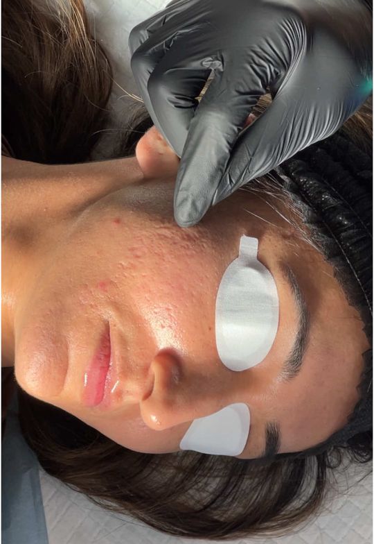 Video by Dr. Nadir Qazi: Understanding your unique acne scars is the first, most crucial step in achieving real improvemen…