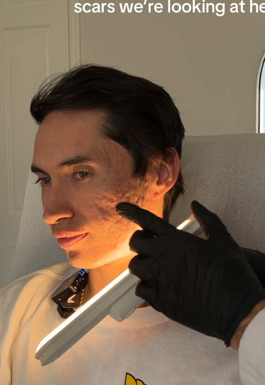 Video by Dr. Nadir Qazi: Just wrapped up an important acne scar diagnosis for a patient struggling with moderate to severe…