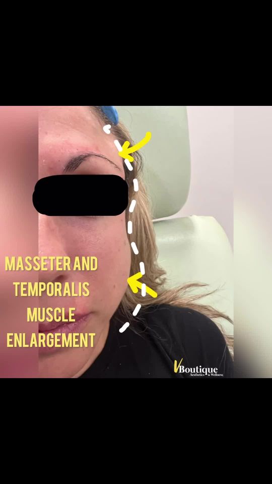 Video by Dr. Neda Vanden Bosch: Watch 👀 the video as I explain this case, an example of severe hypertrophy (enlargement) of mast…