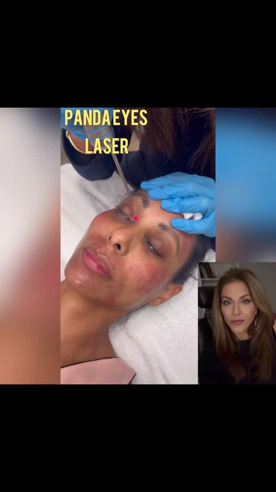 Video by Dr. Neda Vanden Bosch: Panda Eyes Laser Treatment Dark circles 👁️ around the eyes are multi-factorial, but one of the m…