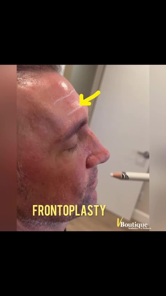 Video by Dr. Neda Vanden Bosch: Watch👀👁️ this short clips to end to see the before and afters of forehead filler!☺️ This handso…