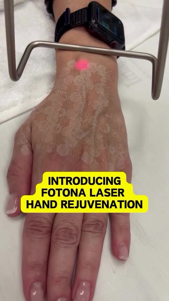 Video by Dr. Neda Vanden Bosch: Fotona Laser Hand Rejuvenation ⚡️ for the back of the hands is a cutting-edge, non-invasive treat…