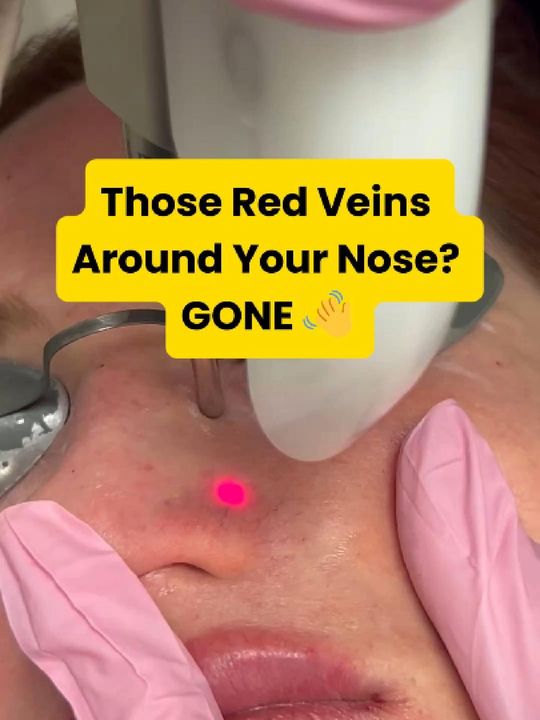 Video by Dr. Neda Vanden Bosch: 👃✨ Say goodbye to those stubborn broken capillaries! ⁣ ⁣ Whether caused by rosacea, sun damage,…