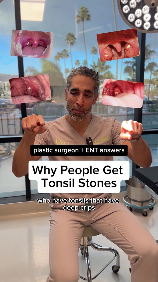 Video by Dr. Nima Shemirani: Have you gotten tonsil stones before?