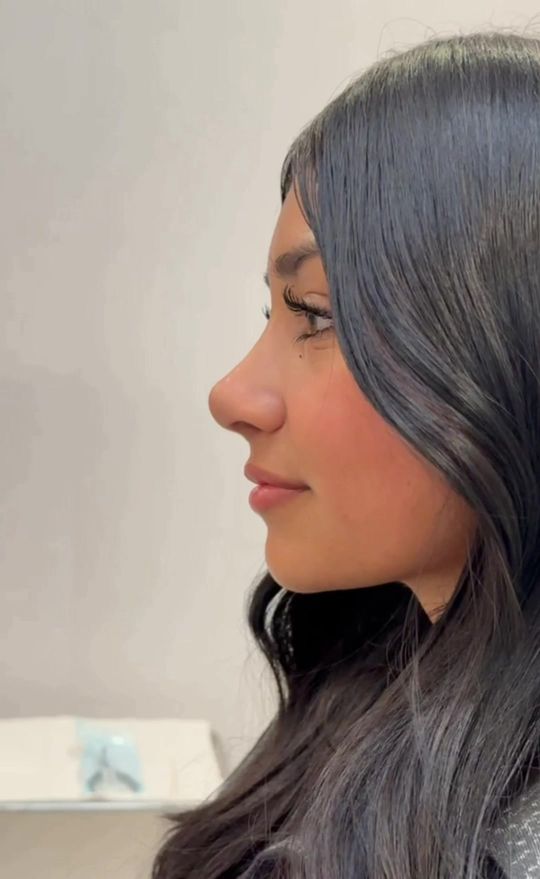 Video by Dr. Nima Shemirani: What a transformation for my patient! 🙌 She came in with a large dorsal hump and a droopy tip an…
