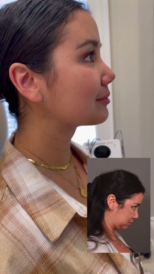 Video by Dr. P. Alex Montague: Deep neck contouring does what liposuction alone cannot! It addresses the underlying structures b…