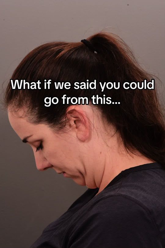 Video by Dr. P. Alex Montague: It’s possible! Deep neck contouring is doing what no procedure has done before! We aren’t just re…