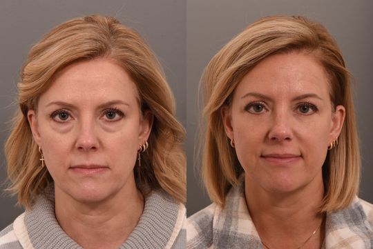 Video by Dr. P. Alex Montague: Looking 20 years younger after a lower eyelid procedure! Dr. Quatela removed her under eye bags w…