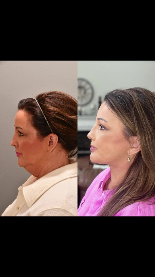 Video by Dr. P. Alex Montague: And that someone is us 💪🏼 THIS is what a facelift is supposed to look like! Facelift or neck li…