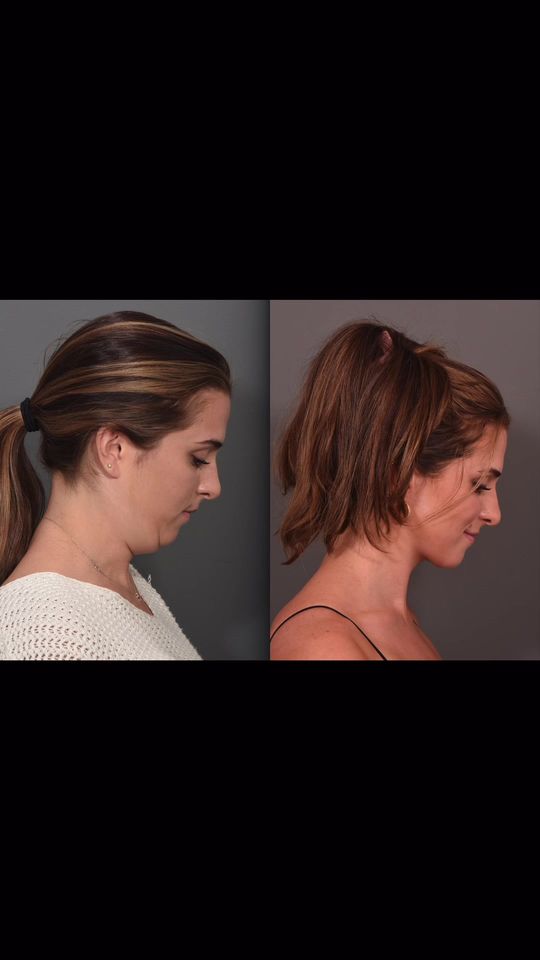 Video by Dr. P. Alex Montague: Deep neck contouring is a surgical procedure that allows us to access the deep structures of the…