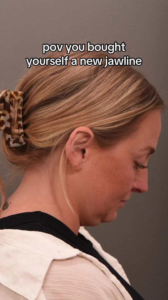 Video by Dr. P. Alex Montague: Worth. Every. Penny!!! 6 months out from deep neck contouring with Dr. Quatela! This patient came…