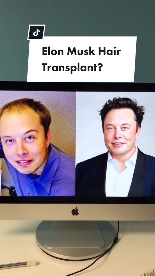 Video by Dr. Parsa Mohebi: Has Elon Musk had a hair transplant? Lemme shed some light 💡🙌🏽 |