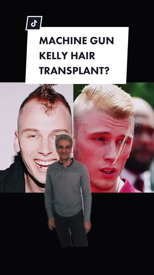 Video by Dr. Parsa Mohebi: MACHINE GUN KELLY HAIR TRANSPLANT?