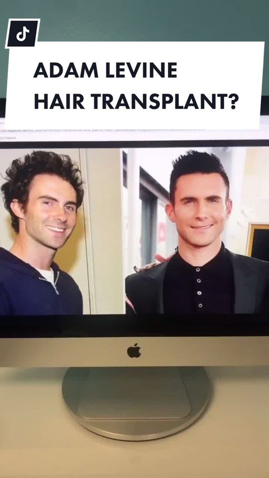 Video by Dr. Parsa Mohebi: ADAM LEVINE HAIR TRANSPLANT?|