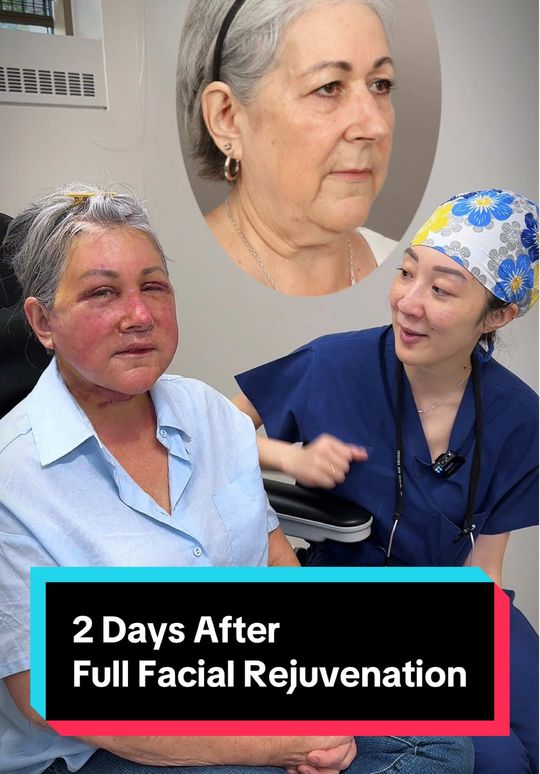 Video by Dr. Paul G. Ruff IV: 🎥 48 Hours After Full Facial Rejuvenation! Meet Tammy, our amazing patient! She came to us feeli…