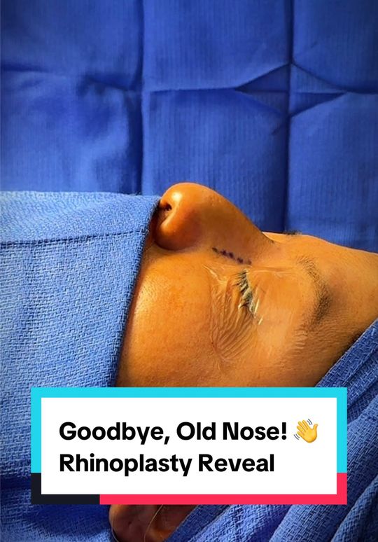 Video by Dr. Paul G. Ruff IV: Goodbye, Old Nose 👋 Hello, New Confidence ✨ This 37-year-old patient came to Dr. Lexie Wang (@dr…