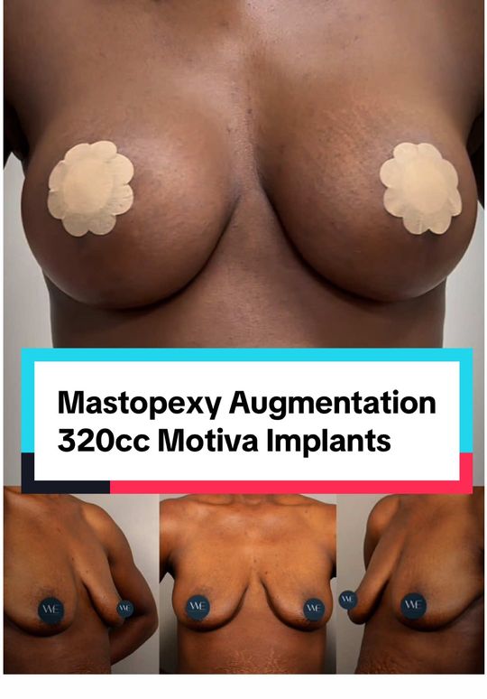 Video by Dr. Paul G. Ruff IV: After multiple pregnancies, this 37-year-old patient wanted to restore both shape and volume to h…