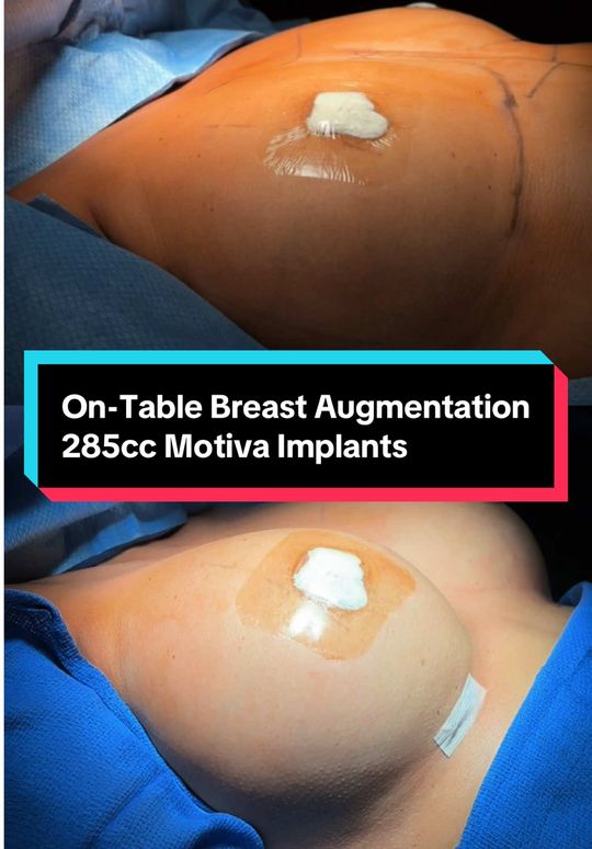 Video by Dr. Paul G. Ruff IV: This 35-year-old patient came to Dr. Arsalan (@Plastic Surgery Doc) wanting to enhance her breast…