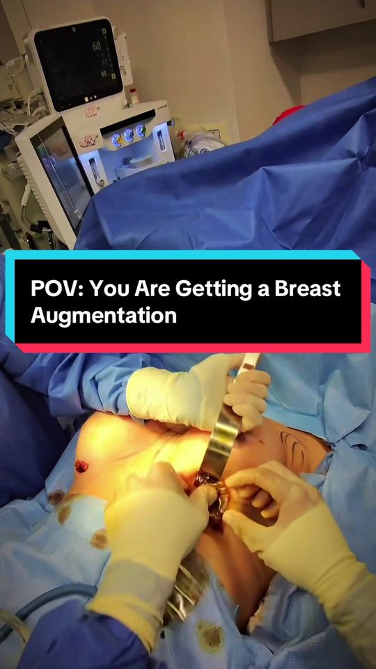 Video by Dr. Paul G. Ruff IV: 👀 POV: Inside the OR with Dr. Arsalan (@Plastic Surgery Doc) A breast augmentation captured from…