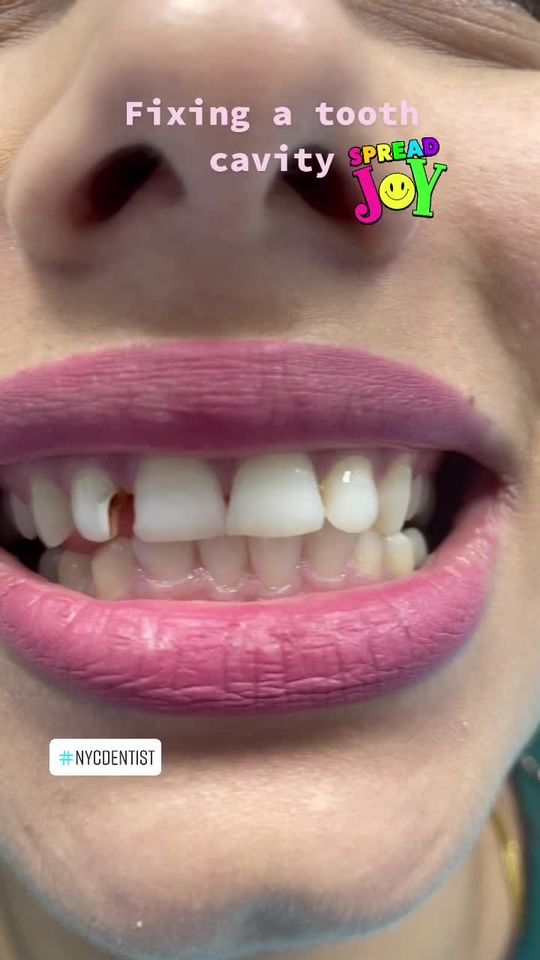 Video by Dr. Peter Mann: Fixing a tooth cavity with a filling.