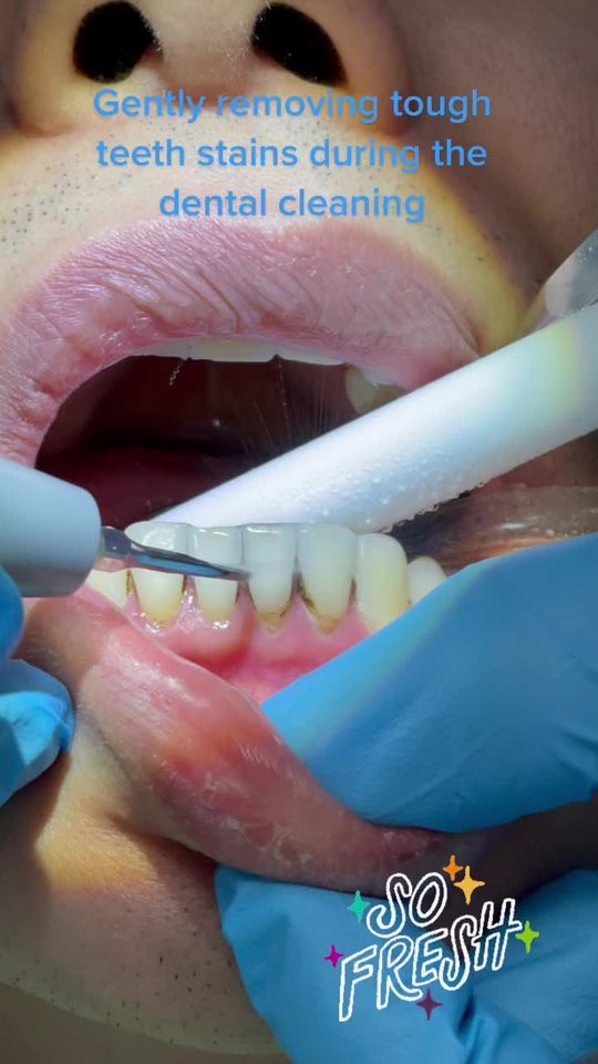 Video by Dr. Peter Mann: A gentle Dental cleaning removes tough stains caused by coffee, tea, etc….