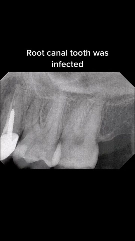 Video by Dr. Peter Mann: Replacing infected tooth with a dental implant.