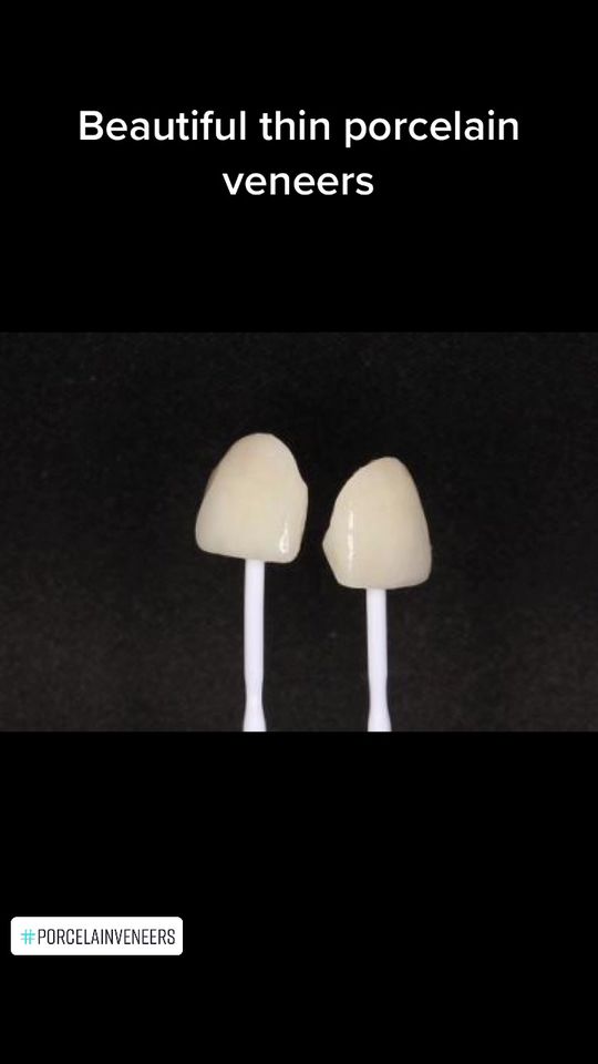 Video by Dr. Peter Mann: Restoring worn out front teeth with beautiful thin porcelain veneers.
