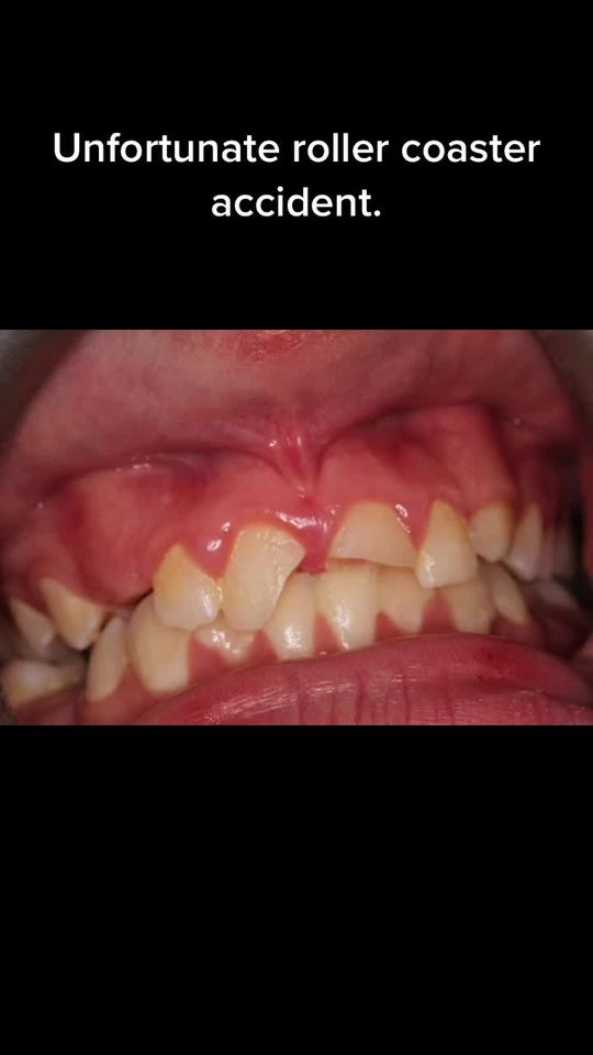 Video by Dr. Peter Mann: Unfortunate roller coaster accident fractured two front teeth. Fortunately we were able to save t…