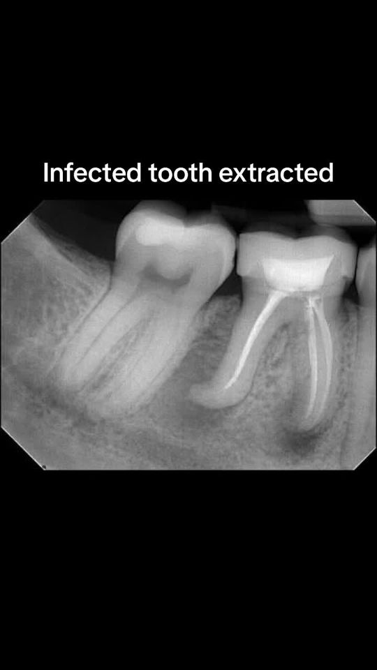 Video by Dr. Peter Mann: Dental implant placement process. @Smile_Arts_of_NY