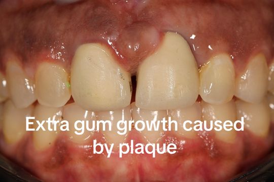 Video by Dr. Peter Mann: Lasered excess gingiva and replaced two front crowns.