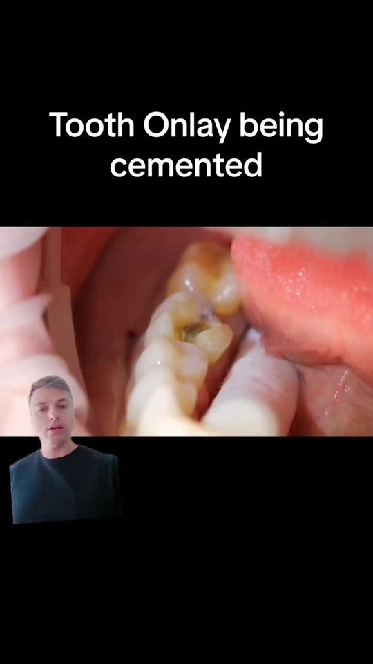 Video by Dr. Peter Mann: What’s an onlay? Dentist discussing an onlay