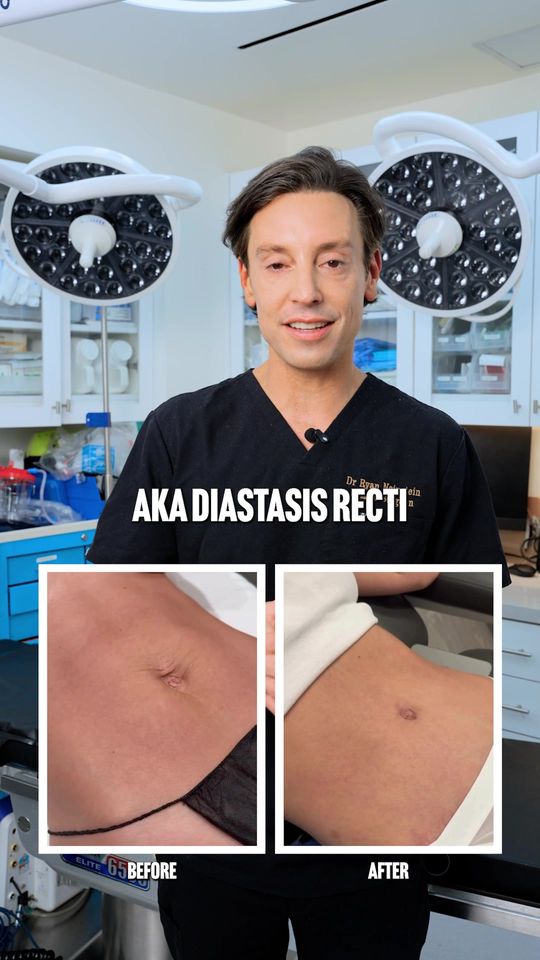 Video by Dr. Pierre Lapaine: Diastasis recti can only be truly fixed with surgery.