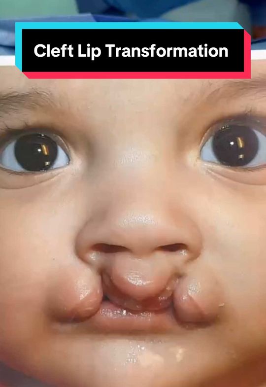 Video by Dr. Rachel A. Ruotolo: Hi 👋🏼 everyone!! Remember yesterday’s She is seen here BEFORE and immediately AFTER her bilater…