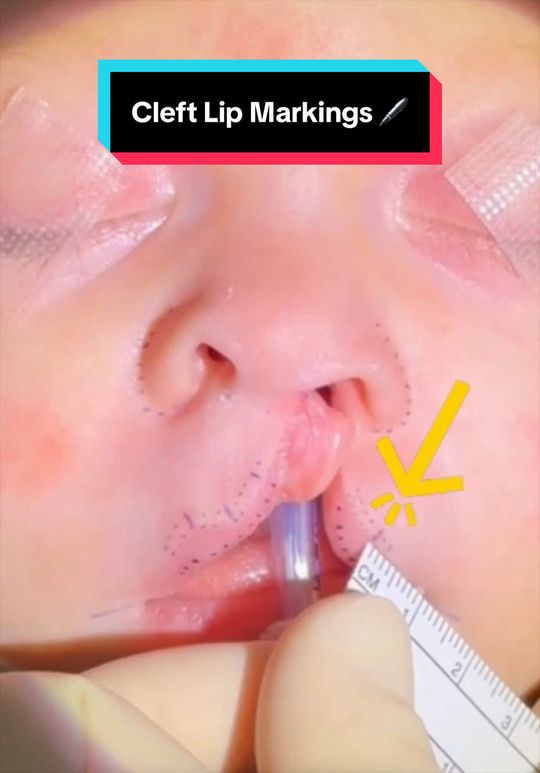 Video by Dr. Rachel A. Ruotolo: Hi 👋🏼 everyone! It’s 🖊️🖊️ Today, I’m highlighting the intra-op markings of a recent LEFT side…