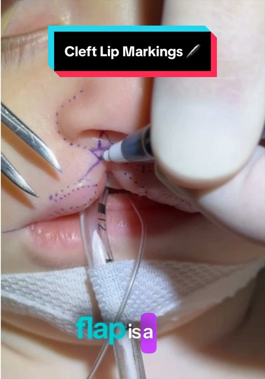 Video by Dr. Rachel A. Ruotolo: Hi 👋🏼 everyone! It’s 🖊️🖊️ Today, I’m highlighting the intra-op markings of a recent RIGHT sid…