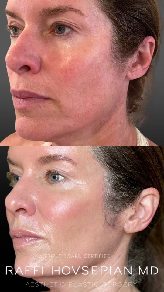Video by Dr. Raffi Hovsepian: Non Surgical Facial Enhancement by Triple Board Certified Plastic Surgeon Dr. Raffi Hovsepian Dr.…