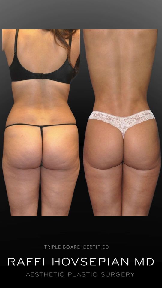 Video by Dr. Raffi Hovsepian: Body sculpting transformation by Triple Board-Certified Plastic Surgeon Dr. Raffi Hovsepian. This…