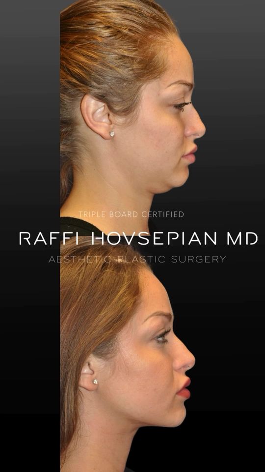 Video by Dr. Raffi Hovsepian: “The Model Makeover Jawline-Neck Enhancement” procedure pioneered by Triple Board-Certified Plast…