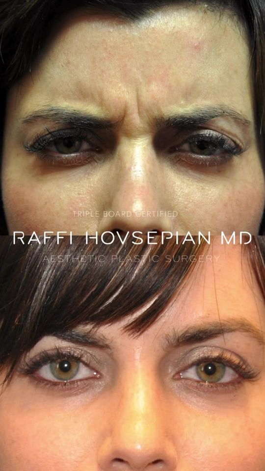 Video by Dr. Raffi Hovsepian: Achieve Youthful Radiance with Dr. Raffi Hovsepian 💉 The Do’s and Don’ts of Botox 💉 Dr. Raffi H…