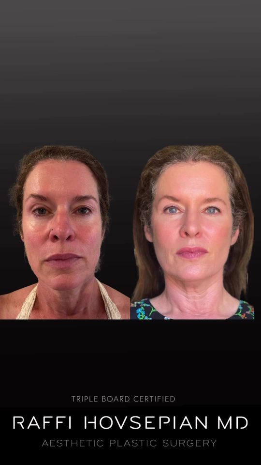 Video by Dr. Raffi Hovsepian: “Non-Surgical” Facial Enhancement by Dr. Raffi Hovsepian Experience the Trinity Lift™ rejuvenatio…