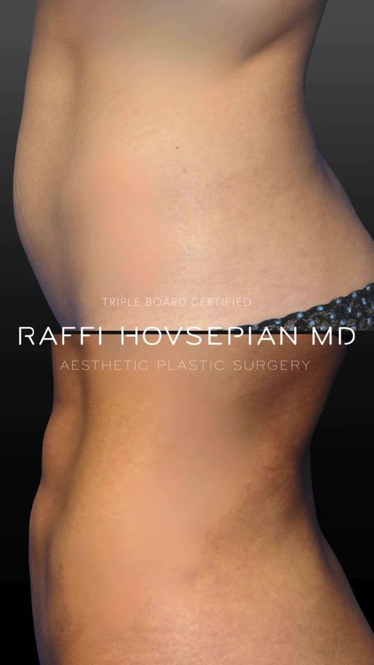 Video by Dr. Raffi Hovsepian: Transformation by Triple Board-Certified Plastic Surgeon, Dr. Raffi Hovsepian…This patient, a mid…