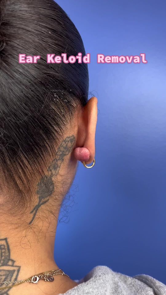 Video by Dr. Raffy Karamanoukian: Ear Keloid Removal 🤩