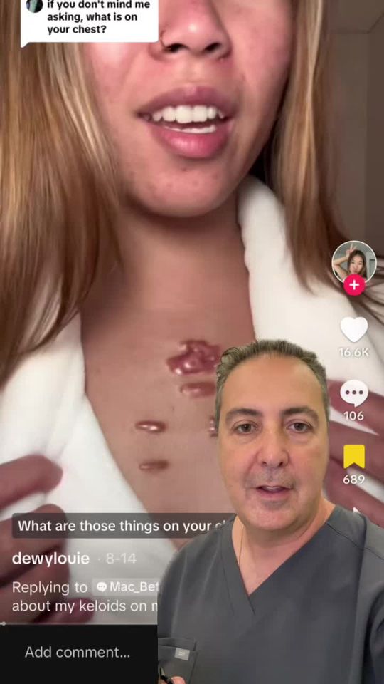 Video by Dr. Raffy Karamanoukian: acne keloids can often occur on the chest and back, and can be caused by a combination of genetic…