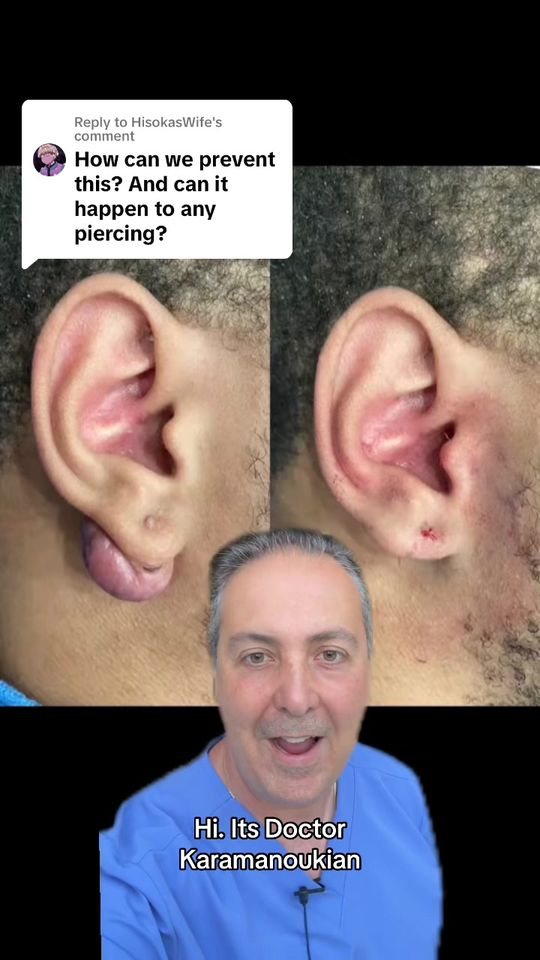 Video by Dr. Raffy Karamanoukian: Replying to @HisokasWife Keloids on the earlobe and ear helix can be devastating. We like the tre…