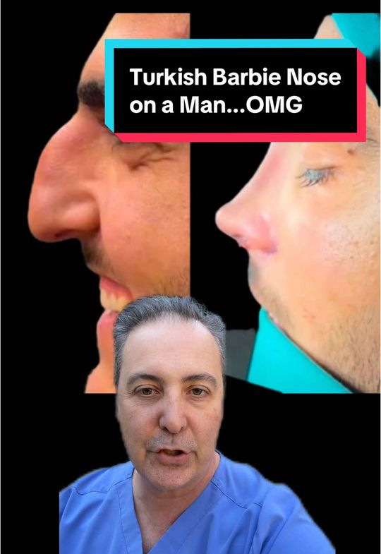 Video by Dr. Raffy Karamanoukian: this is a popular trend in plastic surgery in Turkey and the Middle East known as a Barbie nose r…
