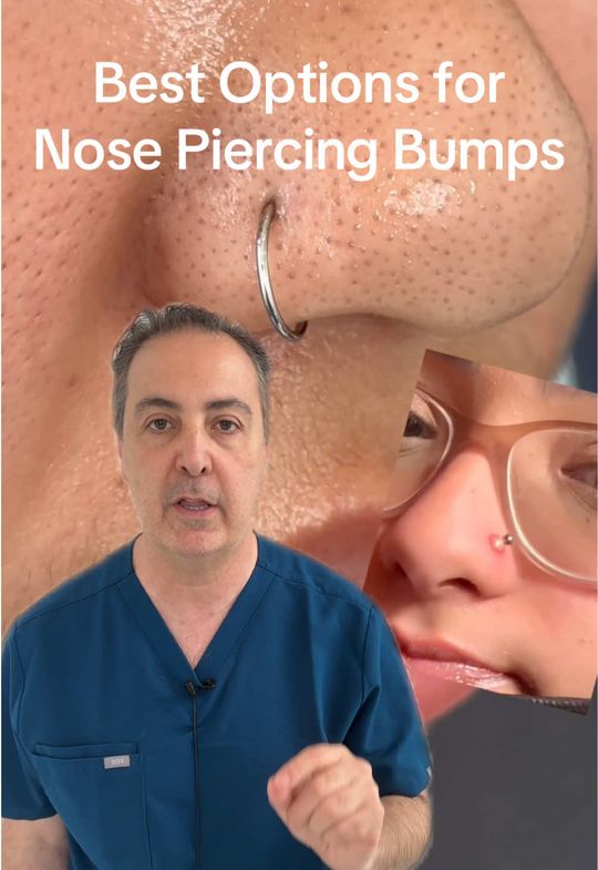 Video by Dr. Raffy Karamanoukian: Are you getting a bump after nostril nose piercing? Talk to the plastic surgery experts at Kare P…