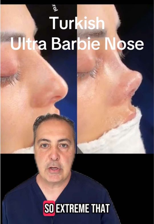 Video by Dr. Raffy Karamanoukian: this is an example of a Turkish Barbie nose rhinoplasty that is so extreme that the surgeon calls…