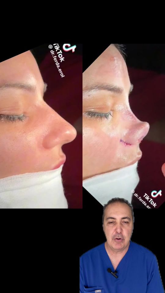 Video by Dr. Raffy Karamanoukian: Turkish Barbie knows rhinoplasty with a severe reduction in the nasal tip and nasal airway as dem…